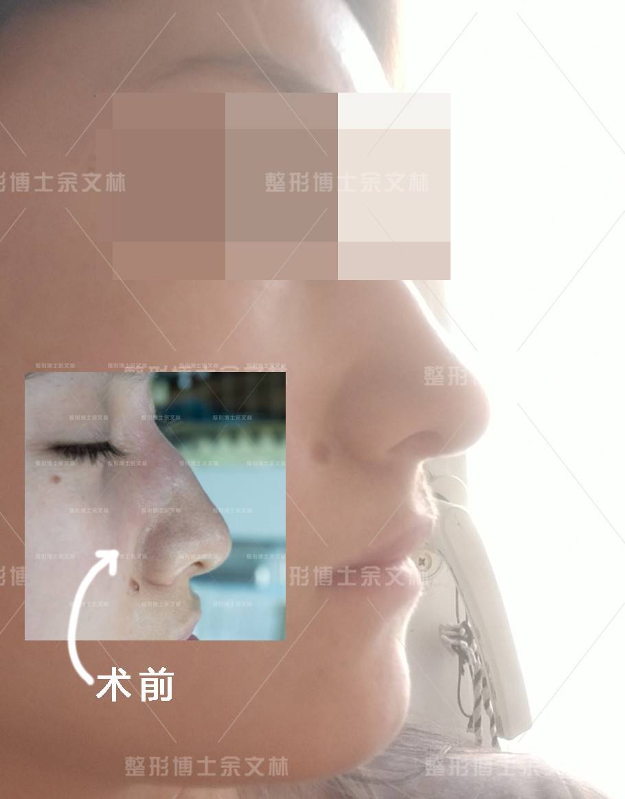 都能唇裂鼻畸形修复 | 唇（腭）裂的鼻子可以整完美吗？