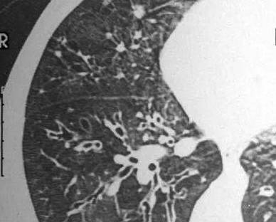 气道|支气管扩张体征、症状与诊断，这一篇文章就够了！│临床必备