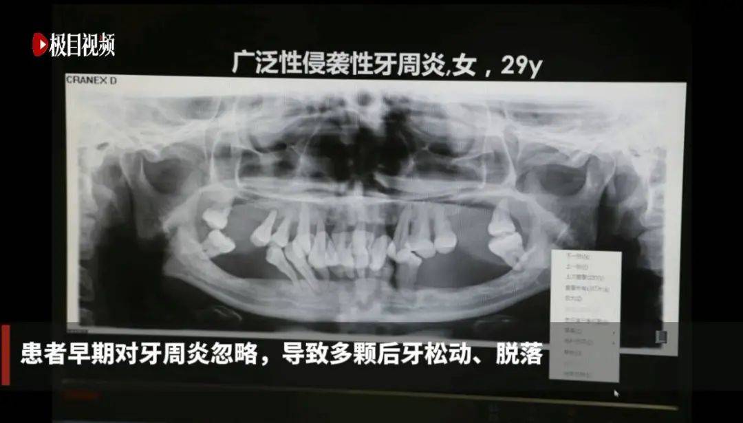 女子|才29岁！女子牙齿掉了一大半，医生一看：剩下的也保不住了