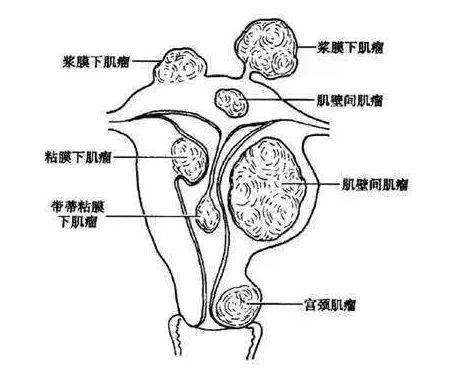 青島濱海學院附院婦科成功完成難度極高的子宮頸肌瘤切除術