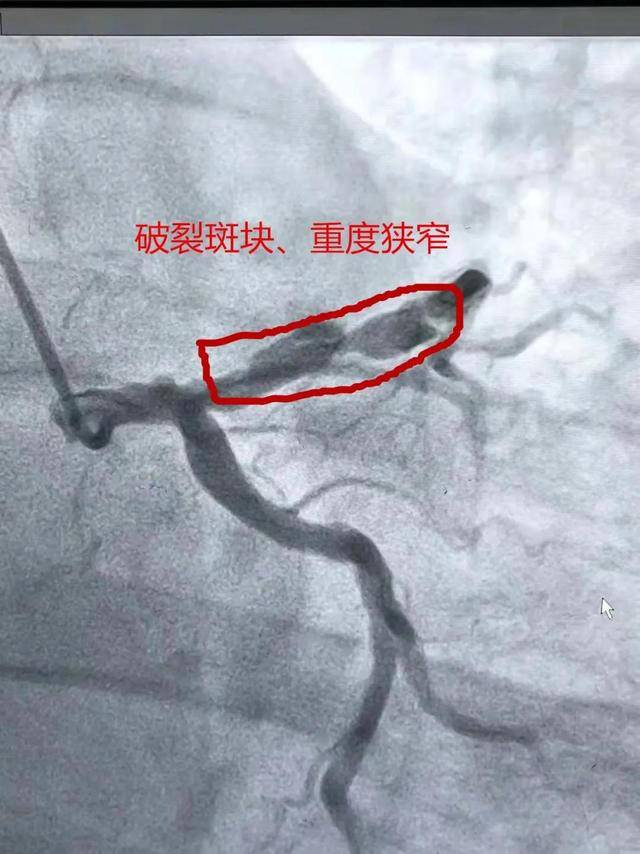 刘大爷|咸阳市第一人民医院：两次手术挽救生命之“心”