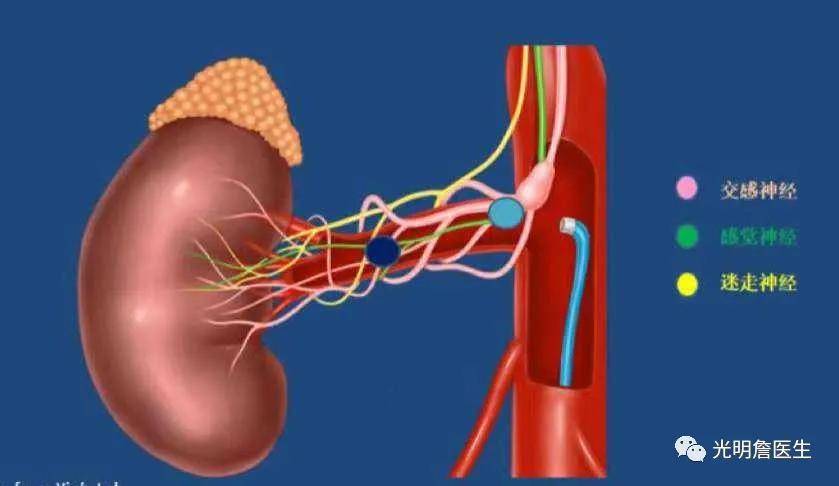 腎動脈去交感神經消融術-給高血壓斷電_研究_心腦血管_治療