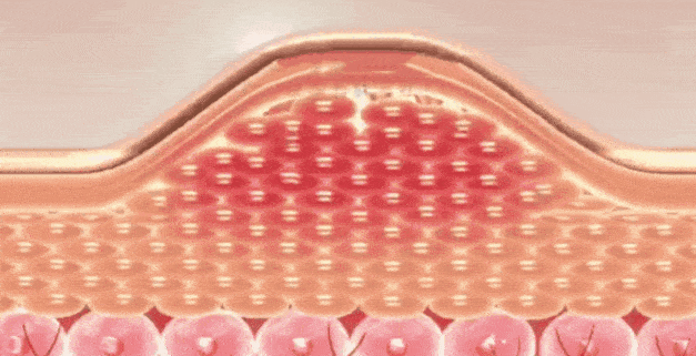 黏液|专家共识:气道廓清呼吸康复治疗,推荐西纳舒盐溶胶治疗仪