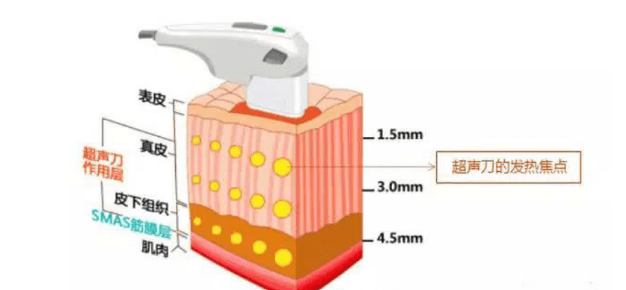 脸部天啊~做完超声刀脸凹陷了怎么办?超声刀后脸部凹陷如何修复?该注意什么?
