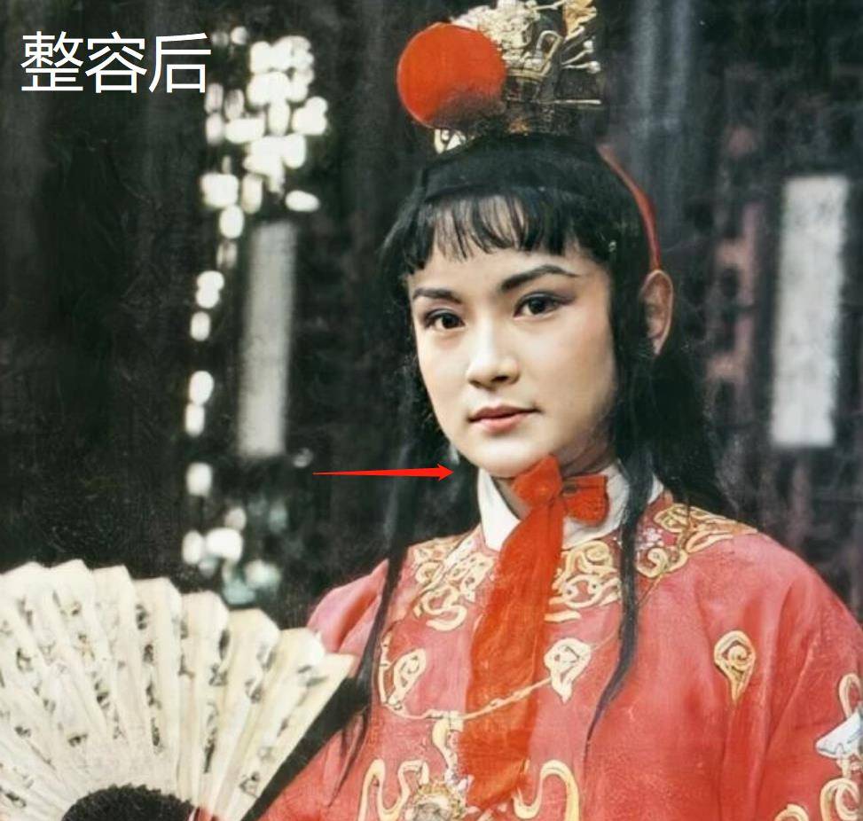 下巴明星频翻车医美需谨慎!有人脸变充气气球,有人下巴变天气预报