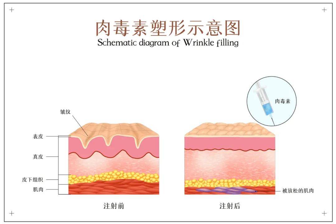 治疗医美知识 | 如何改善皱纹？