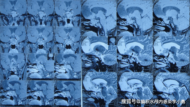 脑垂体切除图片