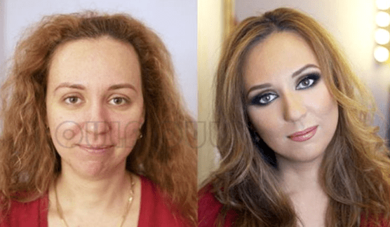 分析分析:热玛吉后多久可以打水光、做完热玛吉多久可以化妆~