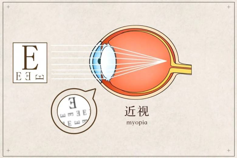 什么方法可以降低散光度数 38facc1f71f346259d42cce6d509b528.jpeg