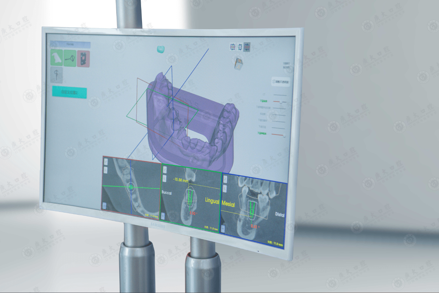 手术|厉害了！老字号广大口腔引进种植牙手术机器人，精准种牙再添动能