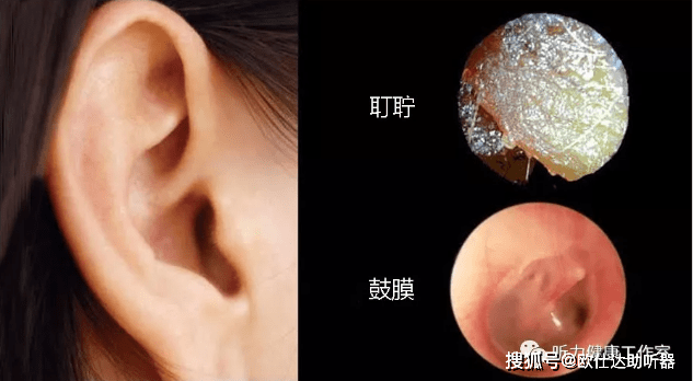 外耳道白色分泌物图片