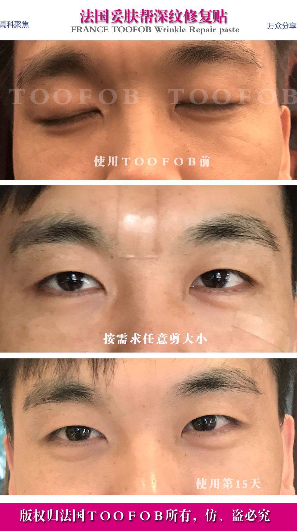 毒素打除皱针5年以上会怎么样？打除皱针打一次就要永远打下去吗？懵~