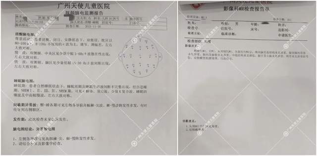 陈主任了解到孩子过往病史后,为俊俊做了针对性的科学检查报告:脑电图