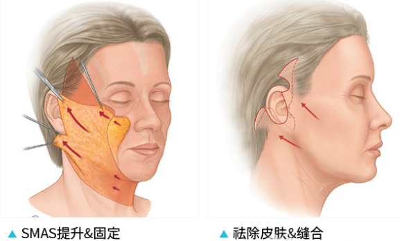 范围拉皮除皱·“面积”篇 ——拉皮切口大，不代表除皱面积大