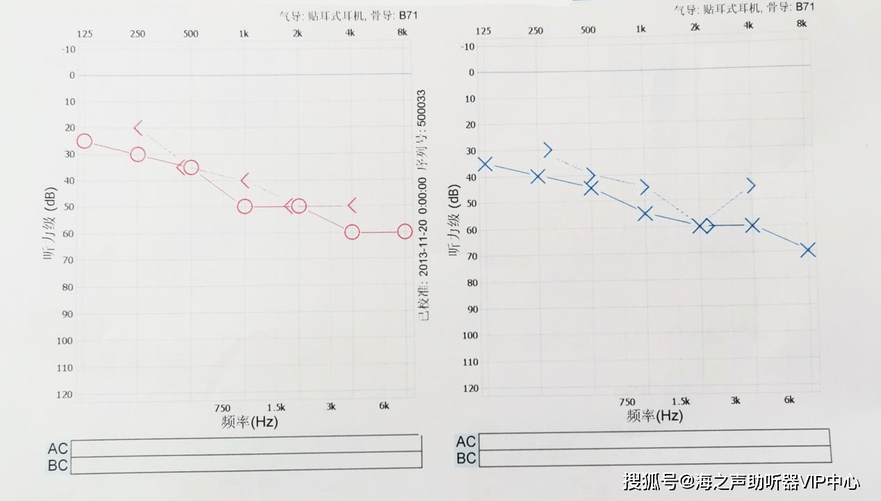 教你通过听力图看自己的听损性质_损失_差值_纯音