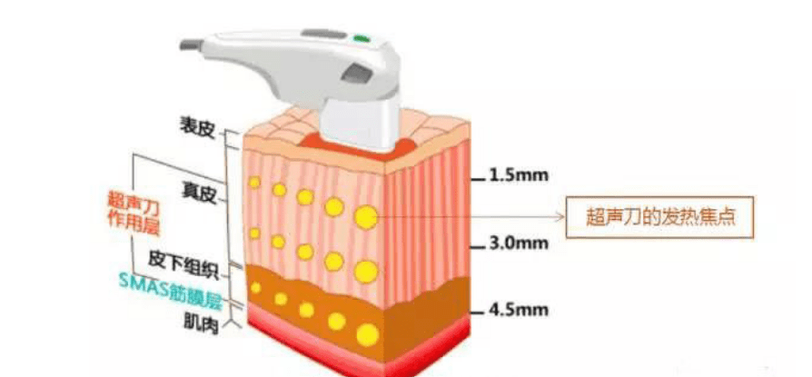 脸部做超声刀的好处和坏处：超声刀后6个月脸部松弛？真相令人意外
