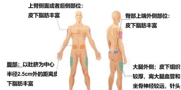 单位|糖尿病患者须知：打1个单位的胰岛素，可以降多少血糖？