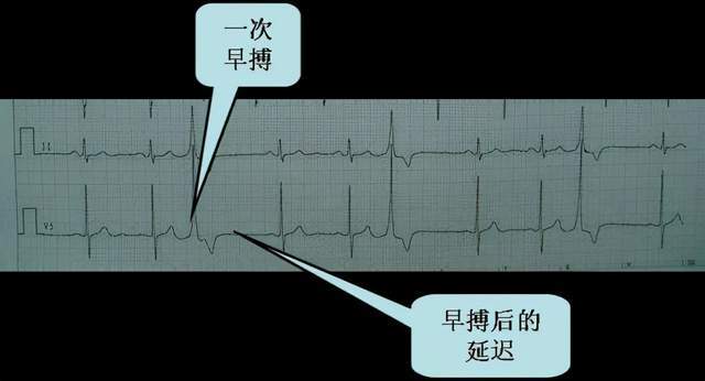 心脏早搏最佳治疗方法图片