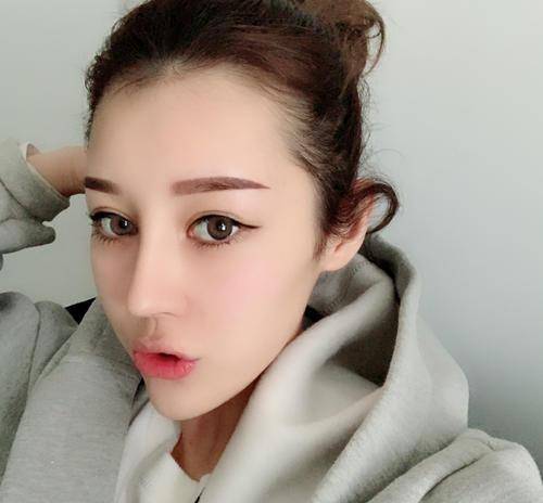 女士贷款2万6隆鼻，手术失败成怪物，人财两空风险下，还有人趋之若附
