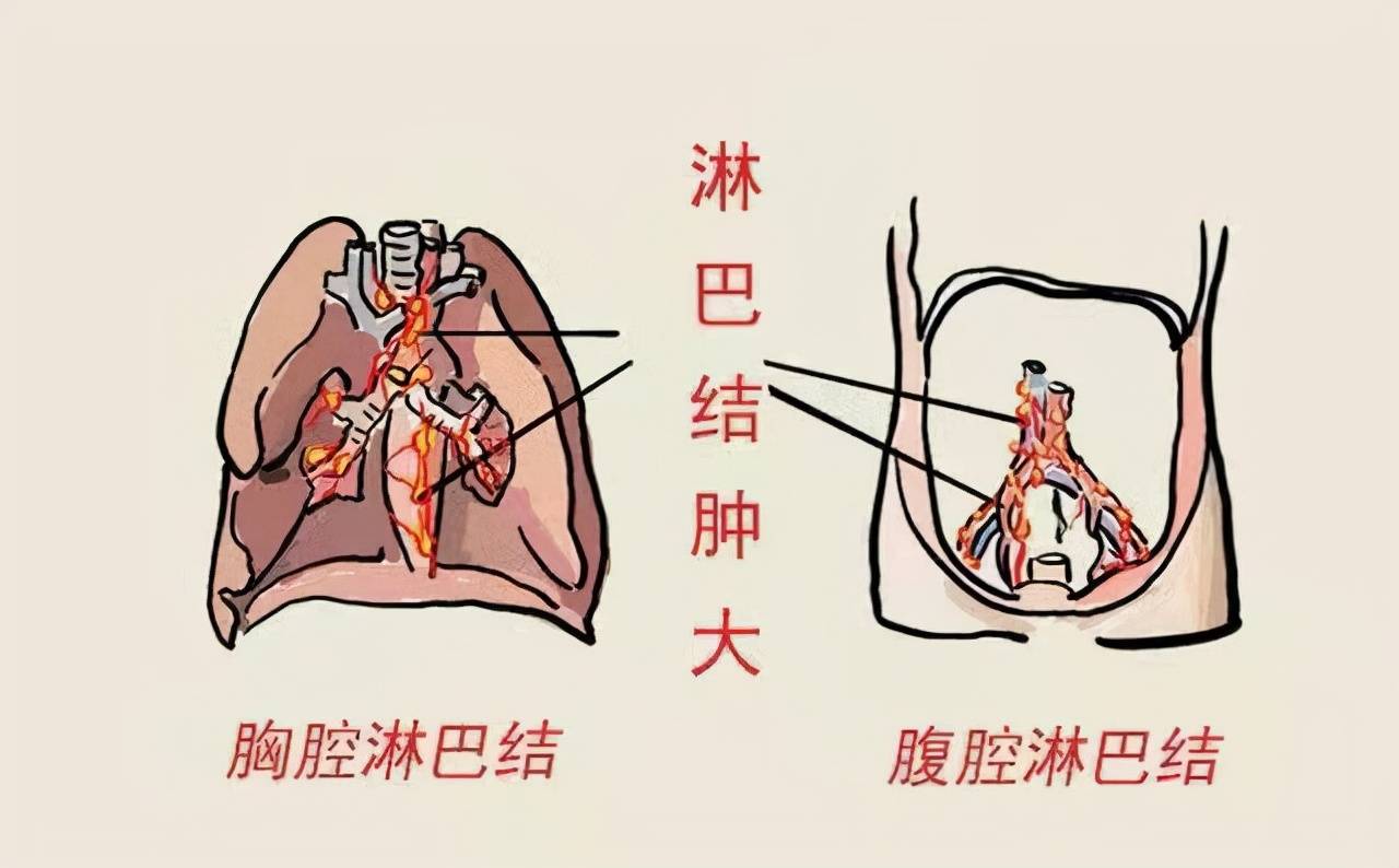 淋巴瘤二如何预防和治疗安琪主任超过75的患者可以治愈