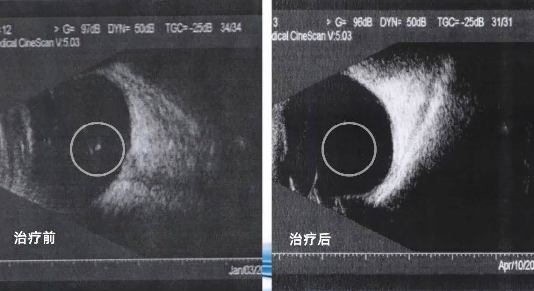 玻璃体混浊weiss环图片图片