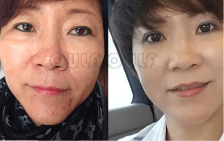 存活率【答疑】脂肪胶需要二次填充嘛？脂肪胶填充脸部可以维持多久？