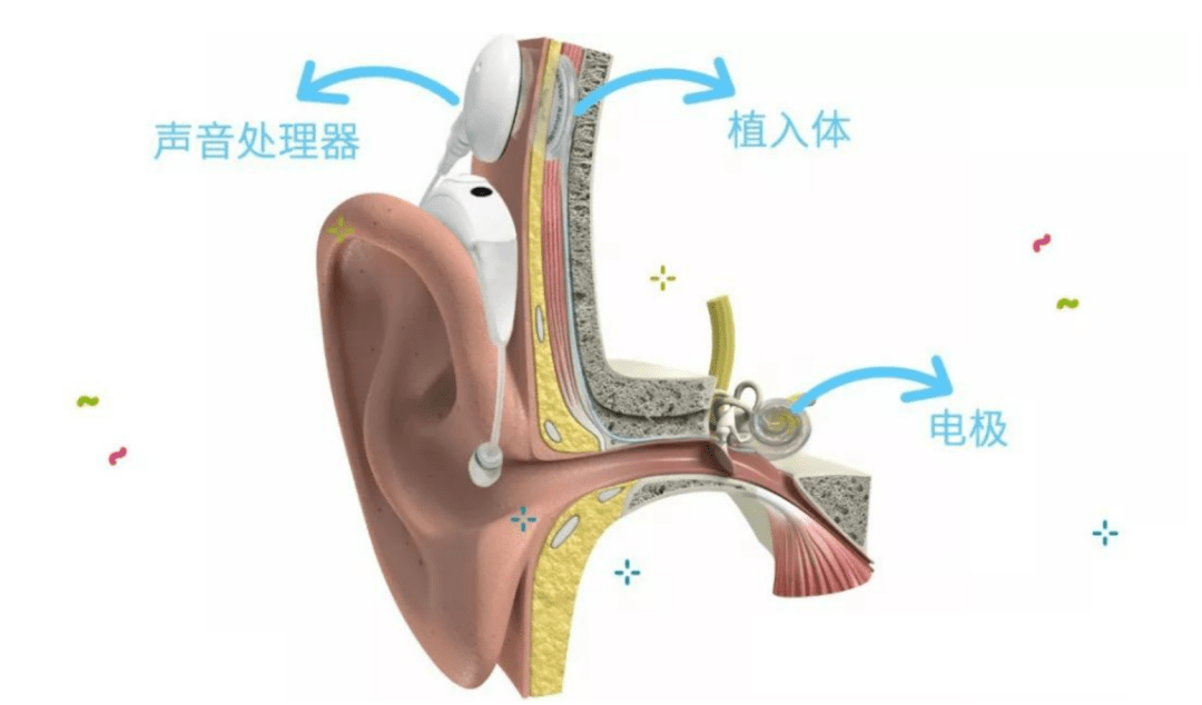 电子耳蜗植入术图片