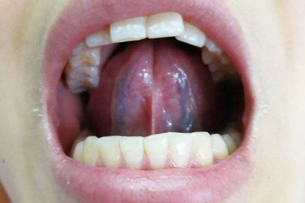 婴儿舌头上有淤血图片图片