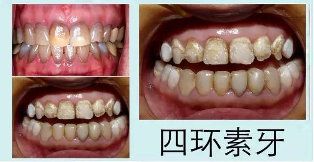 应对办法 由内源性原因造成的牙齿变黄