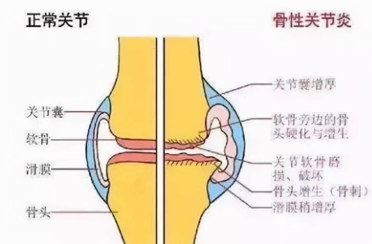 百元大钞|人的膝关节只能用60年？平常不运动能省下来吗，专业医师告诉你