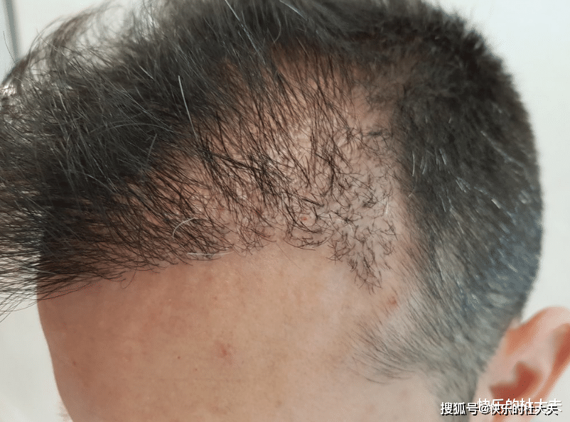 头发少想用他人毛囊治脱发是好是坏告诉你真相