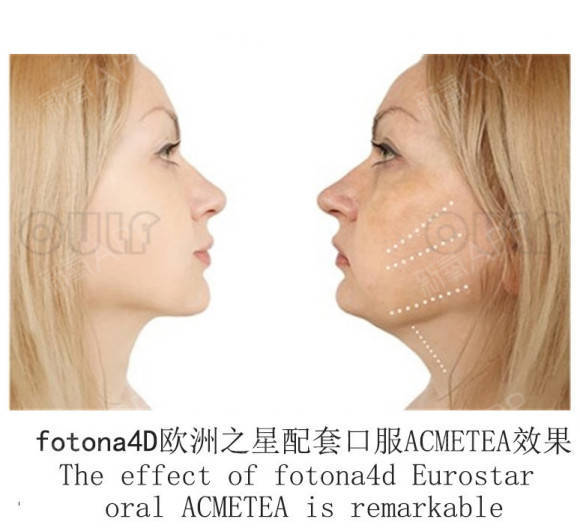 治疗实测欧洲之星fotona4dpro效果怎么样,真的那么有用吗