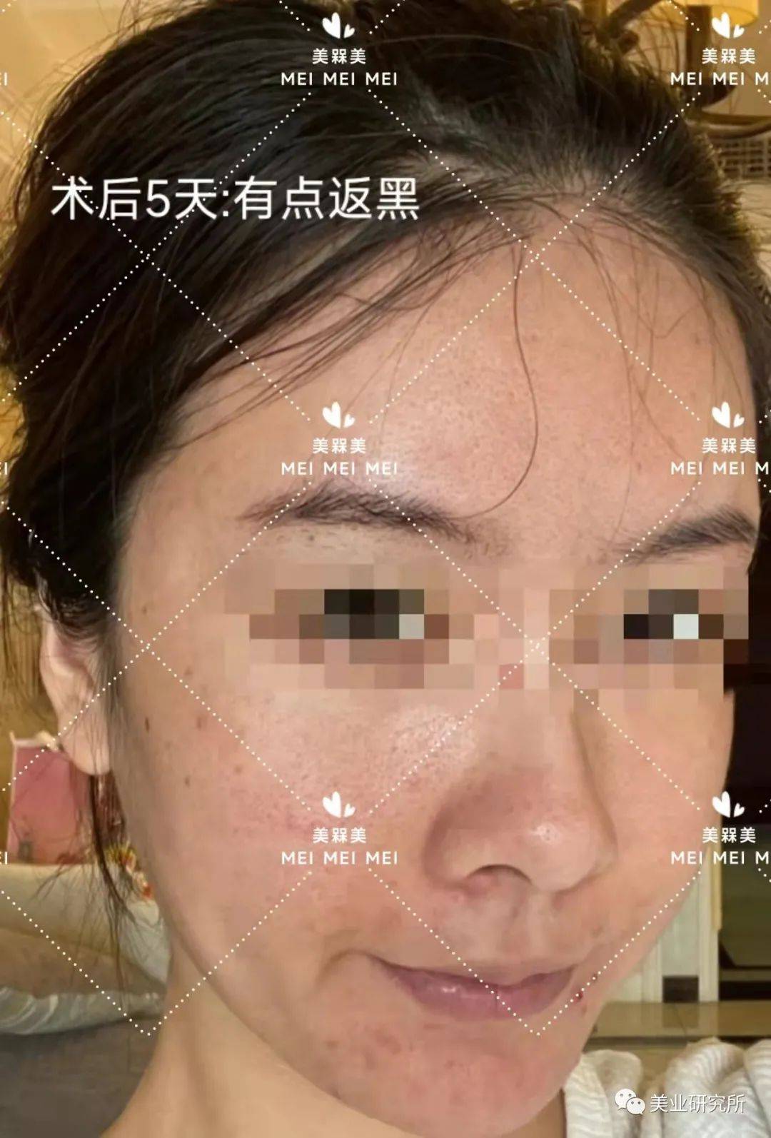 消息资讯【美人汇】拯救痘痘肌，还原婴儿肤