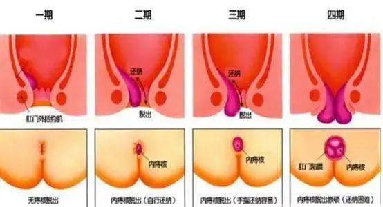 大便|贵阳东大肛肠医院：知道内痔外痔的区别