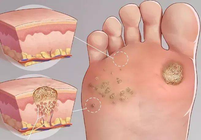 這也許是病毒感染造成的.它的另一個名字叫:蹠疣.