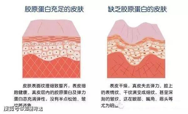 苏打饼干毛孔粗大到像“苏打饼干”？搞清楚是哪种类型的毛孔，才能找到解决方法！