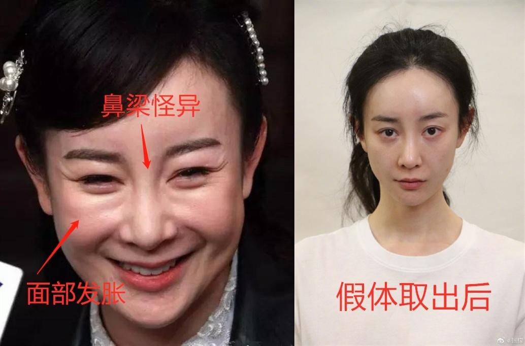 李小璐10位“整容上瘾”的女星，明知硅胶脸恐怖，为何还是前仆后继？！