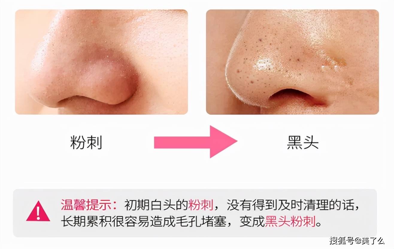 大小如何分辨是脂肪粒还是粉刺？