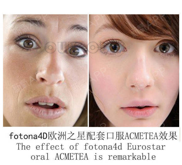 治疗欧洲之星做完多久有效果,隔壁阿姨一把年纪还那么爱美