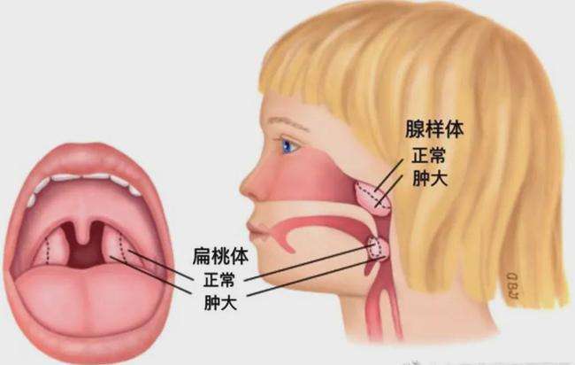 當出現阻塞性的鼻炎時,可以引起睡眠打鼾,主要是鼻腔內的結構異常導致