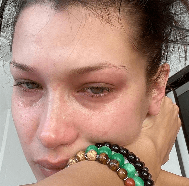 原创维密超模表面光鲜贝拉自曝14岁时隆鼻被抑郁症困扰多年太痛苦