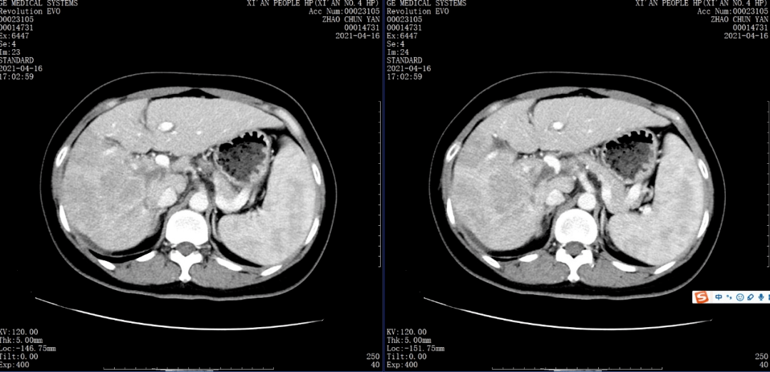 (肝脏增强扫描可见右肝巨大肿瘤)进行甲胎蛋白检查,肝脏增强ct等多项