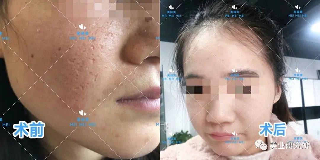 因为【美人汇】痘坑究竟该如何攻克？