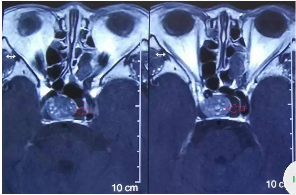 视力|识破“伪装”｜这些症状很可能和垂体腺瘤有关！