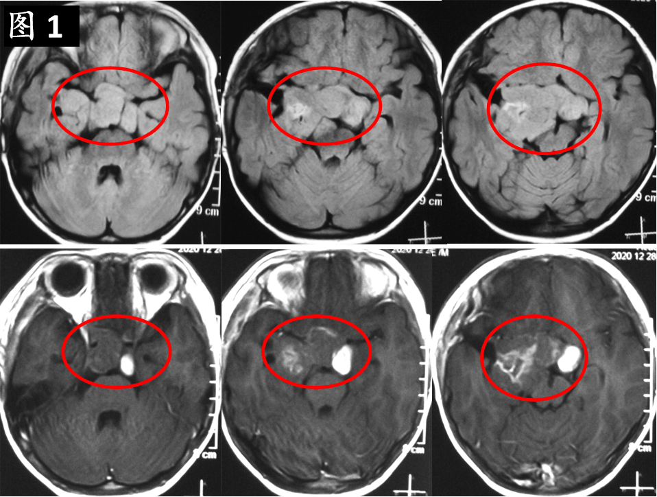 典型病例视路胶质瘤患儿经改良cv方案化疗后效果显著