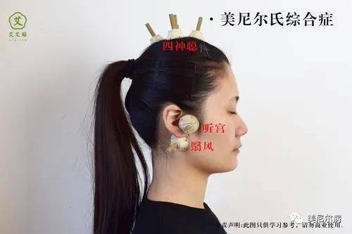 美尼尔眩晕症的禁忌有哪些?_食物_饮食_病人