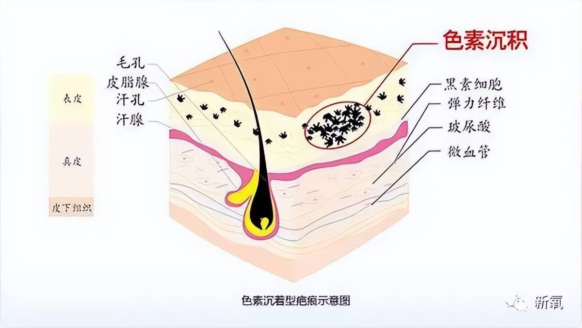 因为安妮海瑟薇是怎么回春的？