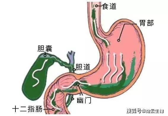 没有关紧"闸口",过多的胆汁反流入胃,胆汁中的胆盐会刺激胃酸分泌