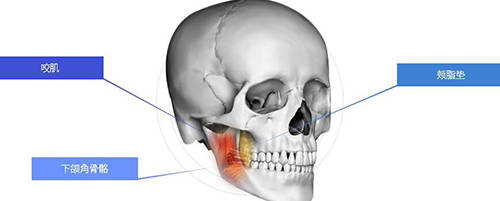 曲线联合丽格第一医院何照华教授详解下颌角失败类型及修复方式