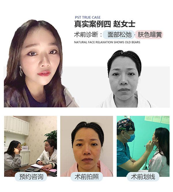 加压面部提升全过程记录，术后30天天我都经历了什么